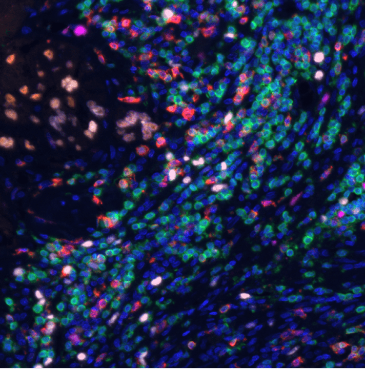 Tumor-involved lymph node (multispectral image)